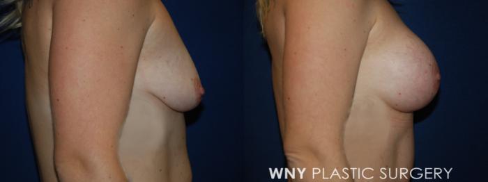 Before & After Breast Augmentation Case 191 Right Side View in Buffalo, NY