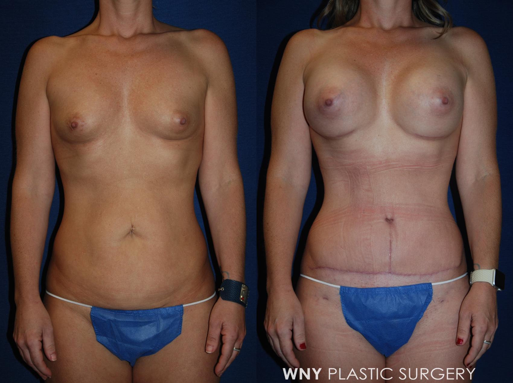 Before & After Tummy Tuck Case 193 Front View in Williamsville, NY