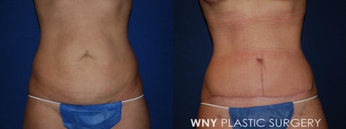 Before & After Mommy Makeover Case 193 Front Lower View in Buffalo, NY