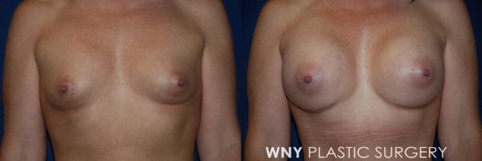 Before & After Tummy Tuck Case 193 Front Upper View in Williamsville, NY