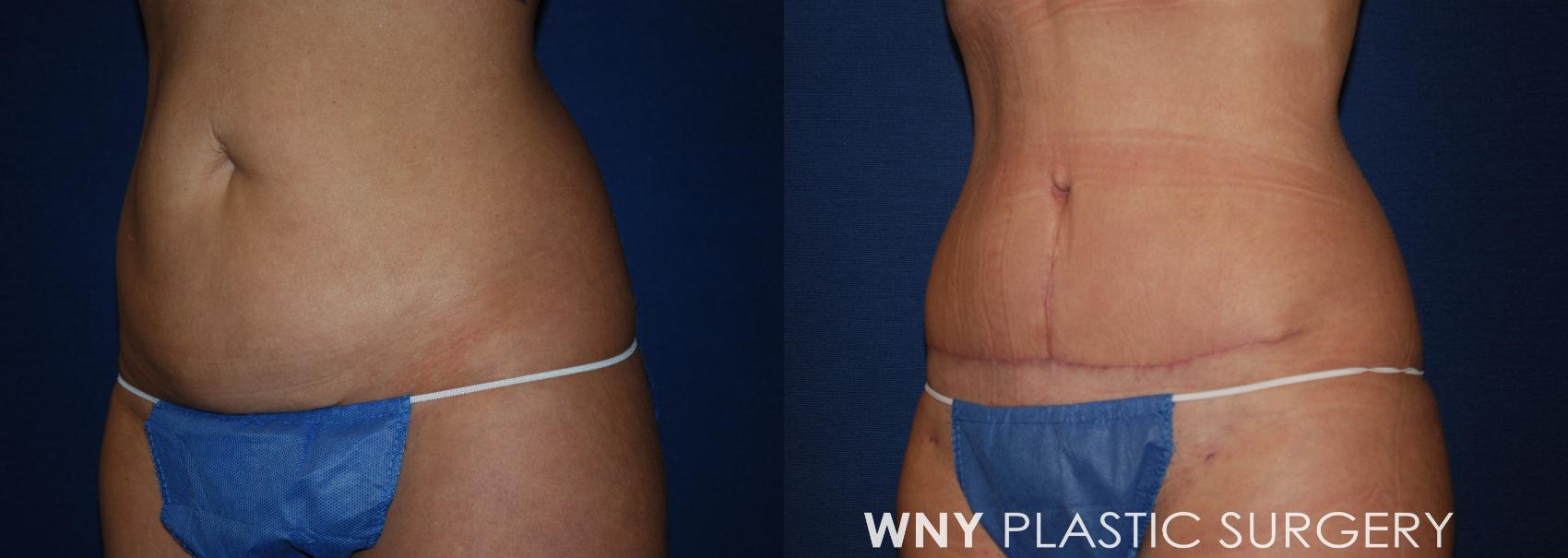 Before & After Mommy Makeover Case 193 Left Oblique View in Williamsville, NY