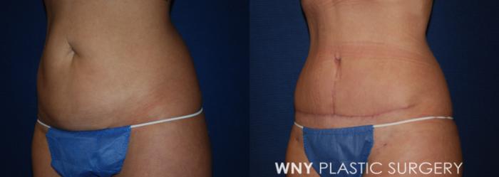 Before & After Mommy Makeover Case 193 Left Oblique View in Buffalo, NY