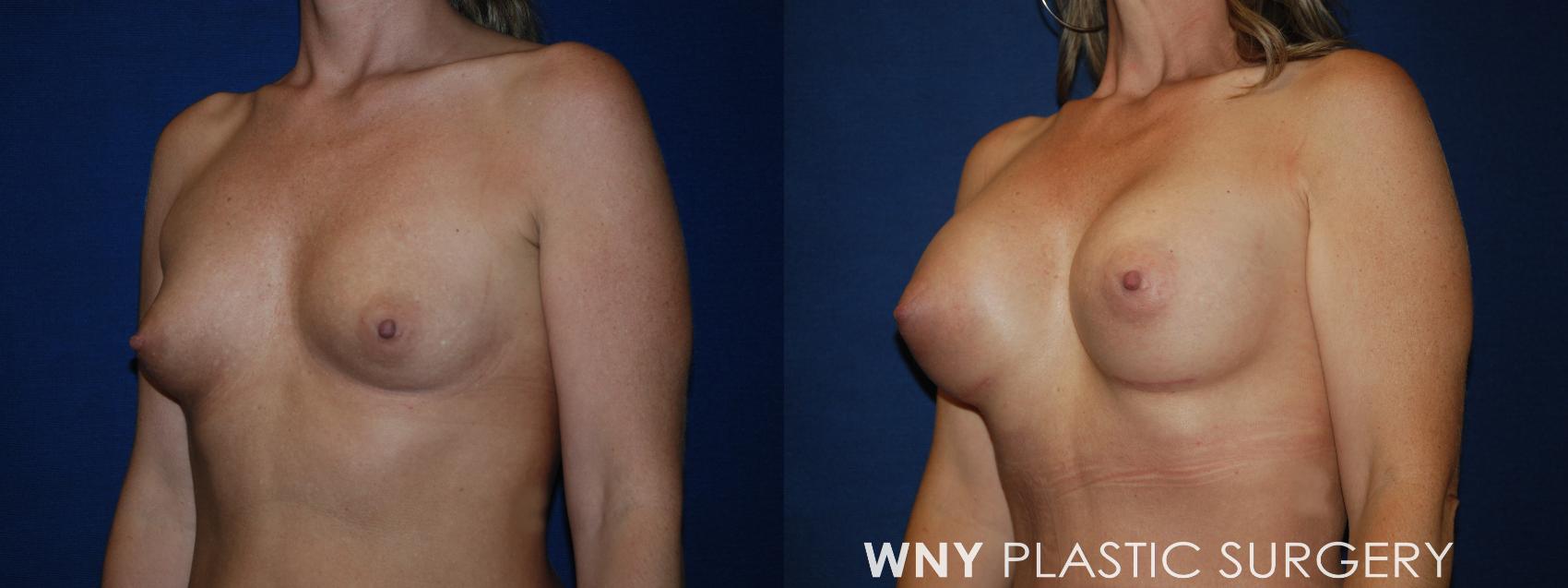 Before & After Mommy Makeover Case 193 Left Oblique Upper View in Williamsville, NY