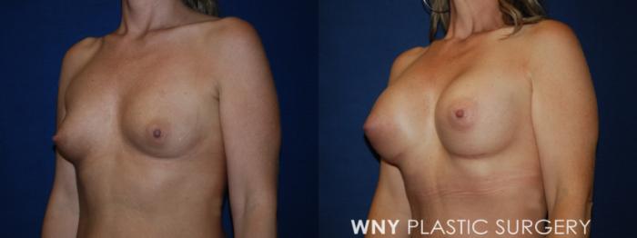 Before & After Breast Augmentation Case 193 Left Oblique Upper View in Buffalo, NY