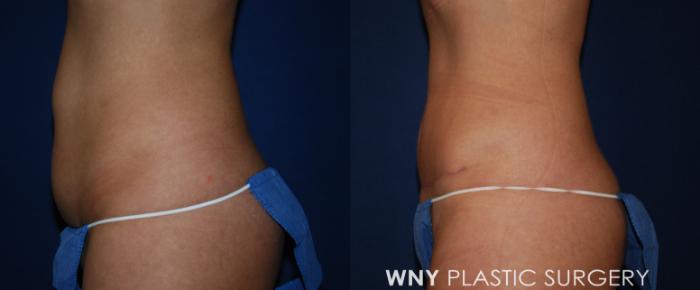 Before & After Breast Augmentation Case 193 Left Side View in Buffalo, NY