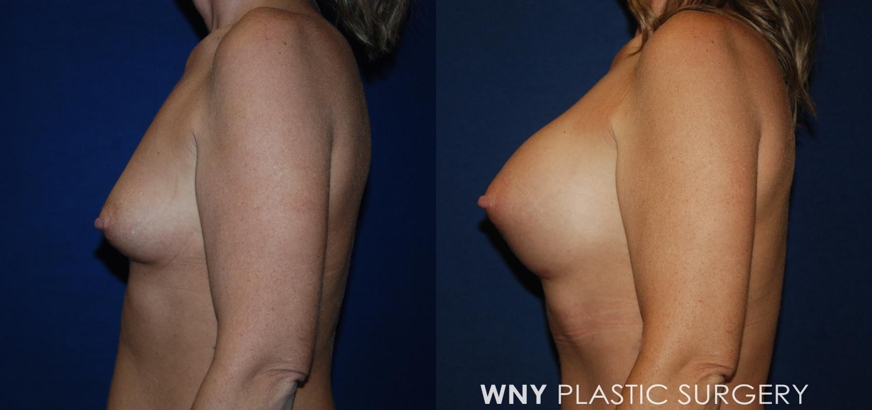 Before & After Mommy Makeover Case 193 Left Upper View in Williamsville, NY