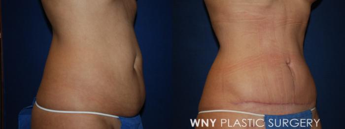 Before & After Tummy Tuck Case 193 Right Oblique Lower View in Williamsville, NY