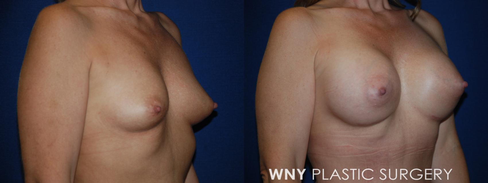 Before & After Mommy Makeover Case 193 Right Upper Oblique View in Williamsville, NY