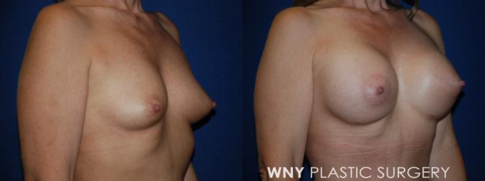 Before & After Breast Augmentation Case 193 Right Upper Oblique View in Buffalo, NY