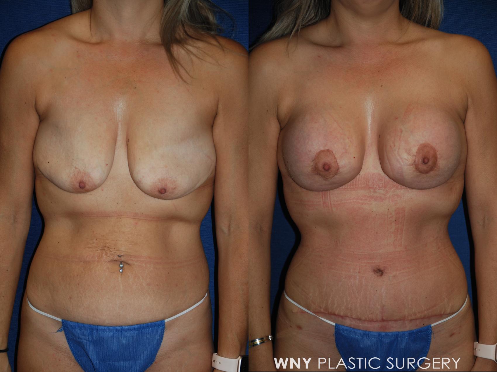 Before & After Tummy Tuck Case 213 Front View in Williamsville, NY