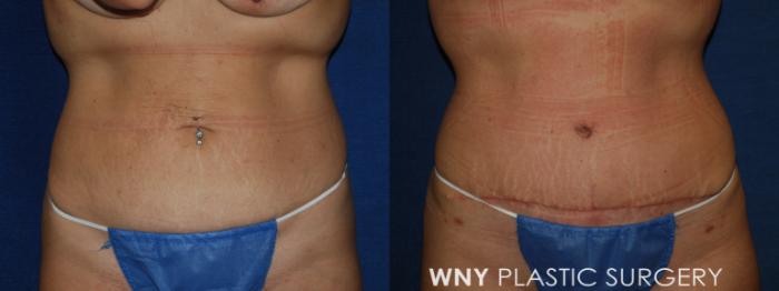 Before & After Breast Lift Case 213 Front Lower View in Buffalo, NY