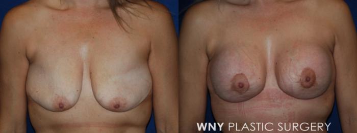 Before & After Breast Lift Case 213 Front Upper View in Buffalo, NY