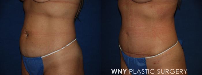 Before & After Tummy Tuck Case 213 Left Oblique Lower View in Buffalo, NY