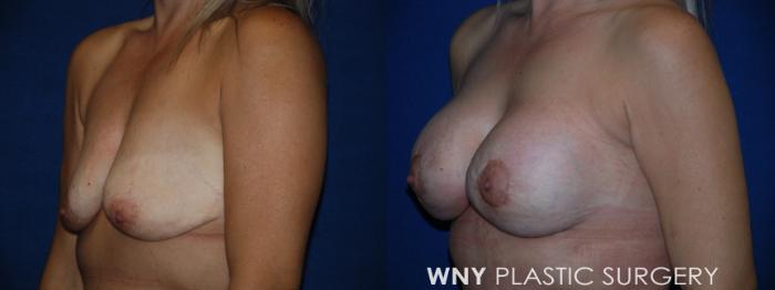 Before & After Breast Augmentation Case 213 Left Oblique View in Buffalo, NY