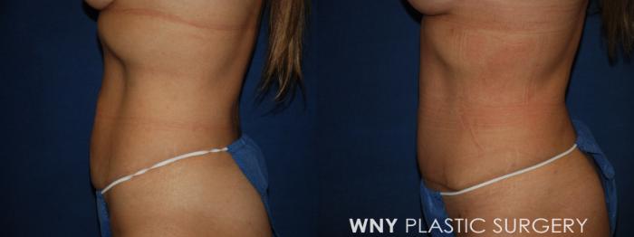Before & After Breast Augmentation Case 213 Left Side Lower View in Buffalo, NY