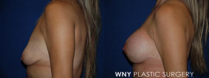 Before & After Breast Augmentation Case 213 Left Side View in Buffalo, NY