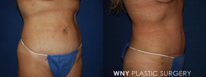 Before & After Tummy Tuck Case 213 Right Oblique Lower View in Buffalo, NY