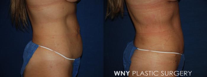 Before & After Tummy Tuck Case 213 Right Side Lower View in Buffalo, NY