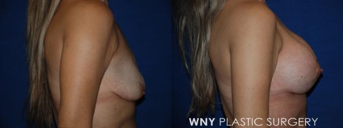 Before & After Breast Lift Case 213 Right Side View in Buffalo, NY