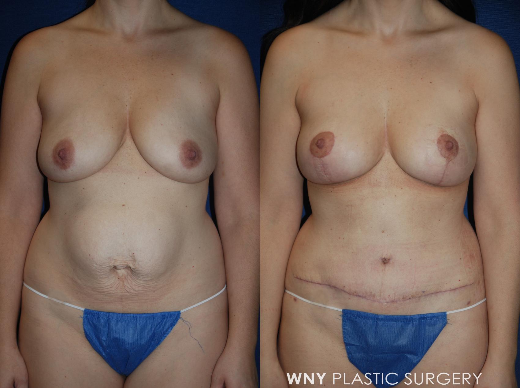 Before & After Mommy Makeover Case 224 Front View in Williamsville, NY