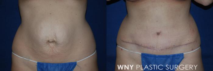 Before & After Tummy Tuck Case 224 Front Lower View in Buffalo, NY