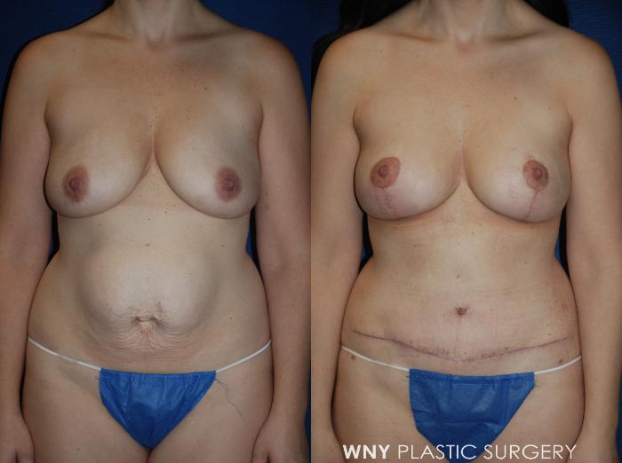 Before & After Tummy Tuck Case 224 Front View in Williamsville, NY