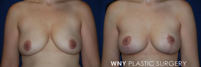 Before & After Breast Lift Case 224 Front Upper View in Buffalo, NY