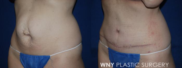 Before & After Mommy Makeover Case 224 Left Oblique Lower View in Buffalo, NY