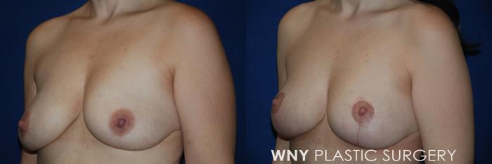 Before & After Breast Lift Case 224 Left Oblique View in Buffalo, NY