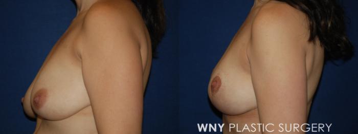 Before & After Breast Lift Case 224 Left Side View in Buffalo, NY