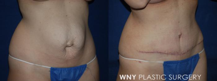 Before & After Tummy Tuck Case 224 Right Oblique Lower View in Buffalo, NY