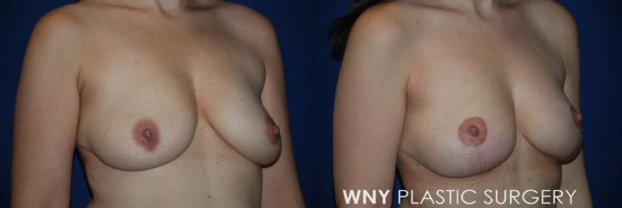 Before & After Breast Lift Case 224 Right Oblique View in Buffalo, NY