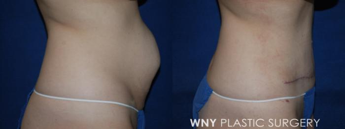 Before & After Tummy Tuck Case 224 Right Side Lower View in Buffalo, NY