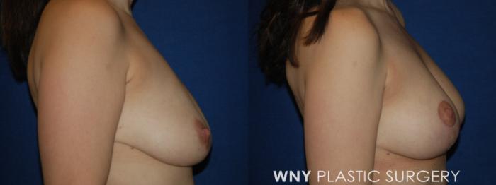 Before & After Breast Lift Case 224 Right Side View in Buffalo, NY