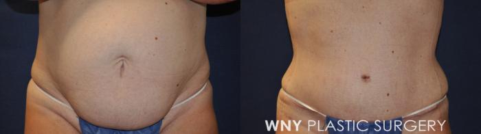 Before & After Breast Augmentation Case 230 Front Lower View in Buffalo, NY