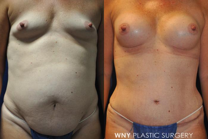 Before & After Breast Augmentation Case 230 Front View in Buffalo, NY