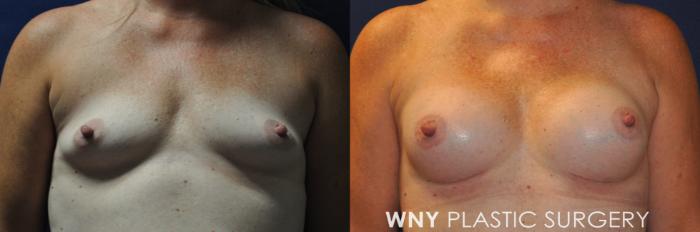 Before & After Breast Augmentation Case 230 Front Upper View in Buffalo, NY