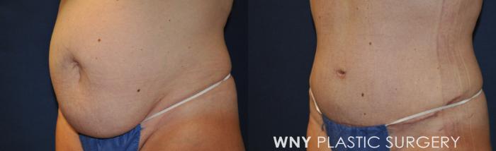 Before & After Breast Augmentation Case 230 Left Oblique View in Buffalo, NY