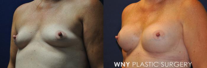 Before & After Breast Augmentation Case 230 Left Oblique Upper View in Buffalo, NY