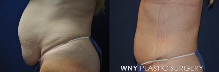 Before & After Tummy Tuck Case 230 Left Side View in Buffalo, NY