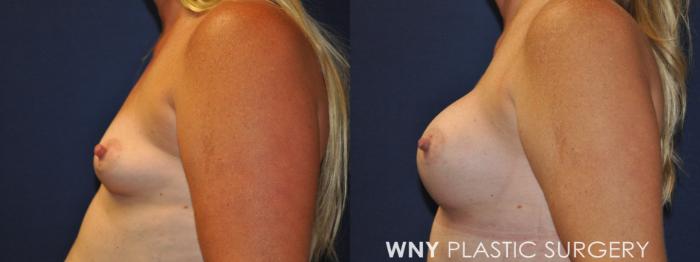 Before & After Mommy Makeover Case 230 Left Side Upper View in Buffalo, NY