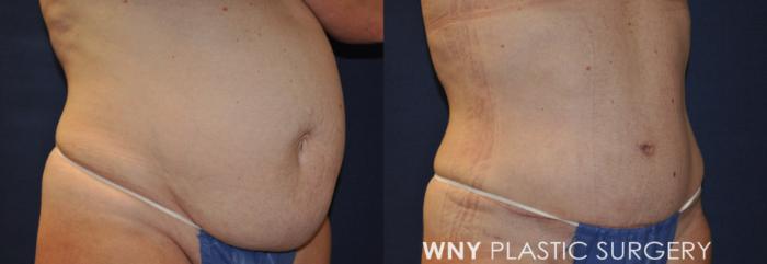 Before & After Mommy Makeover Case 230 Right Oblique View in Buffalo, NY