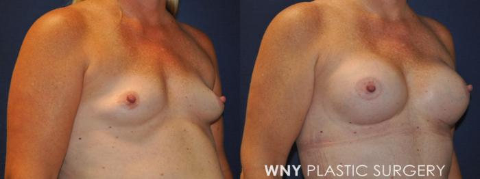 Before & After Tummy Tuck Case 230 Right Oblique Upper View in Buffalo, NY