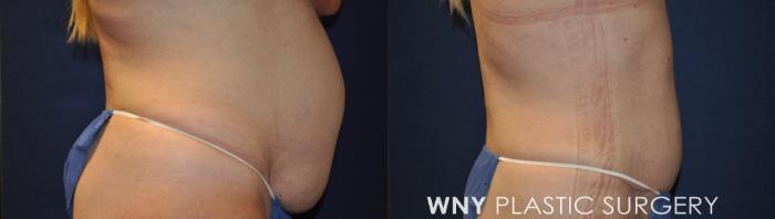 Before & After Breast Augmentation Case 230 Right Side View in Buffalo, NY