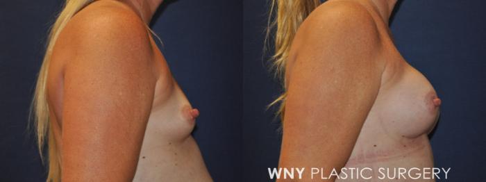 Before & After Tummy Tuck Case 230 Right Side Upper View in Buffalo, NY