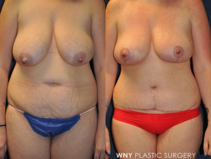 Before & After Breast Lift Case 236 Front View in Buffalo, NY