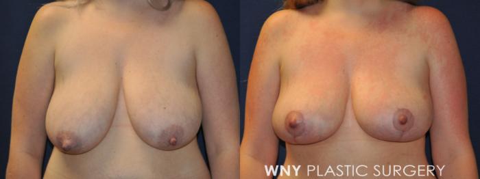 Before & After Breast Lift Case 236 Front Upper View in Buffalo, NY