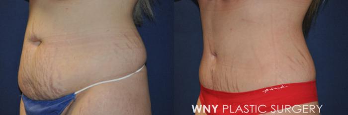 Before & After Mommy Makeover Case 236 Left Oblique View in Buffalo, NY