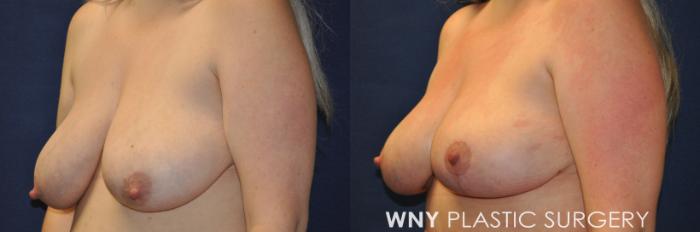 Before & After Mommy Makeover Case 236 Left Oblique Upper View in Buffalo, NY