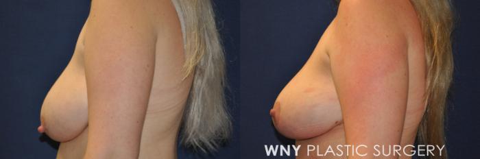 Before & After Breast Lift Case 236 Left Side Upper View in Buffalo, NY